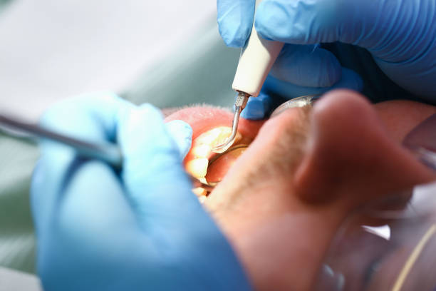 Best Emergency Dental Care for Abscessed Tooth in Chillum, MD