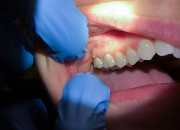 Best Emergency Dental Extractions in Chillum, MD